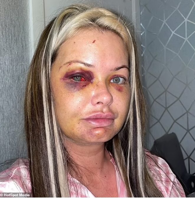 Mother-of-three horrifically Beaten by her boyfriend