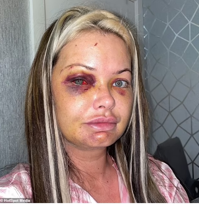 Mother-of-three horrifically Beaten by her boyfriend
